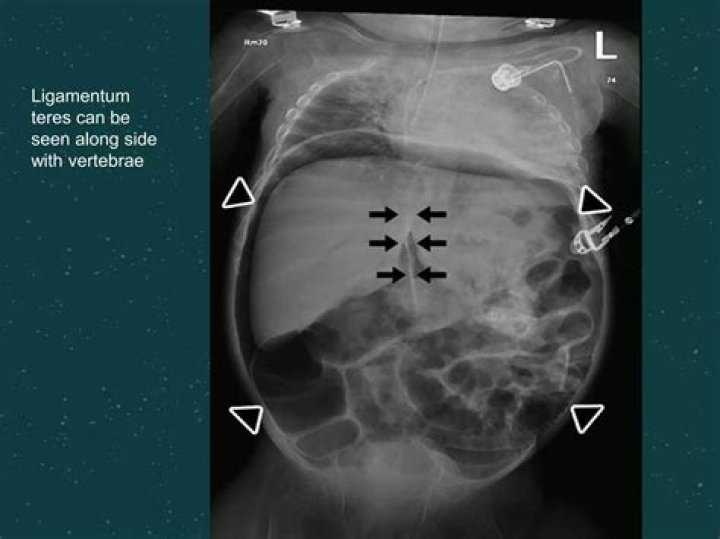 What is pneumoperitoneum laparoscopy?