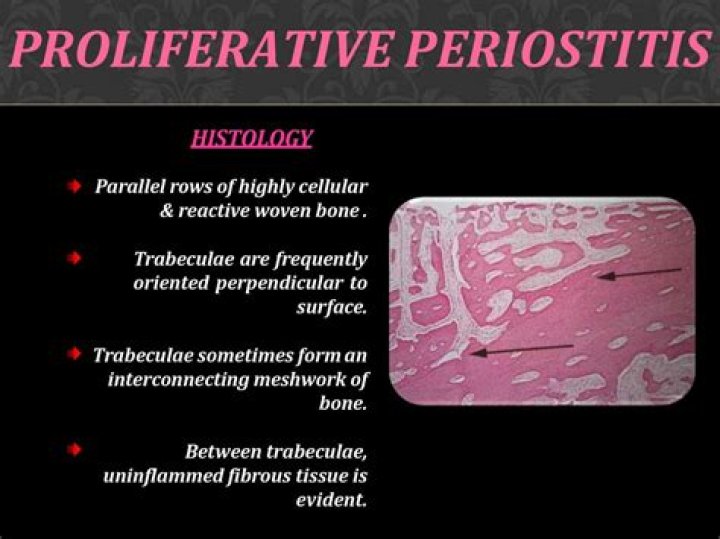 What is proliferative Periostitis?