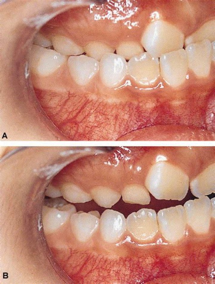 What is pseudo-class 3 malocclusion?