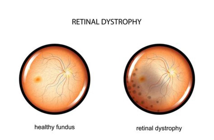 What is retina dystrophy?