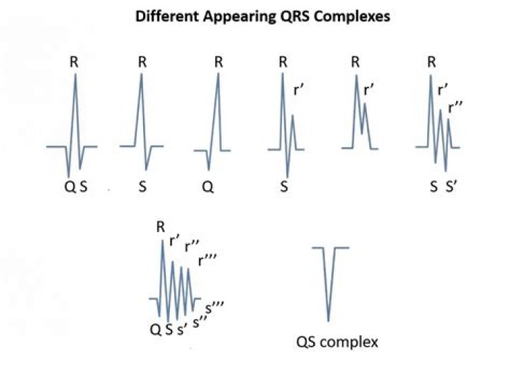 What is RSR pattern in ECG?