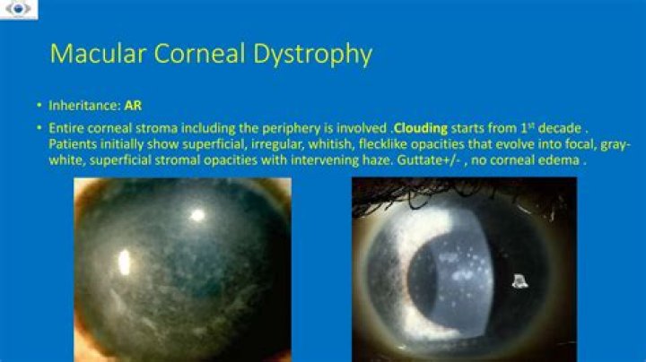 What is Schnyder corneal dystrophy?