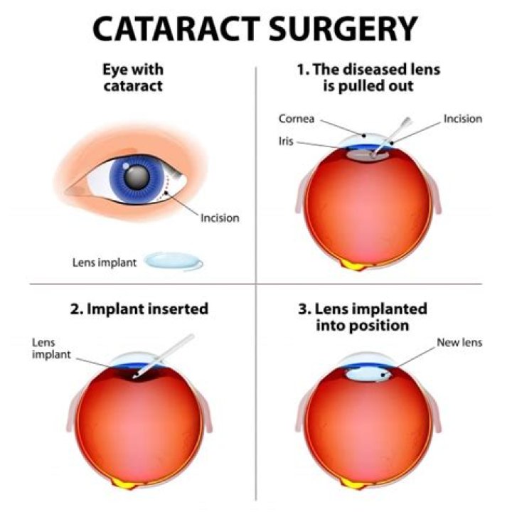 What is Second sight cataract?
