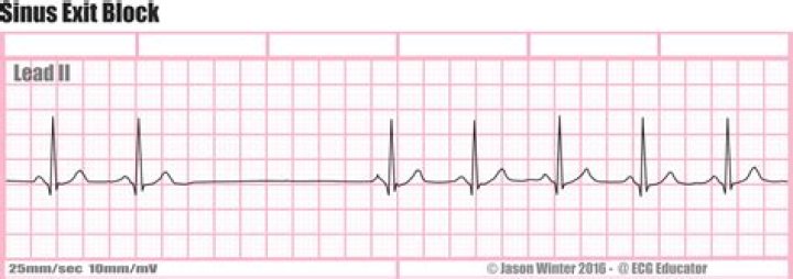 What is sinus node exit block?