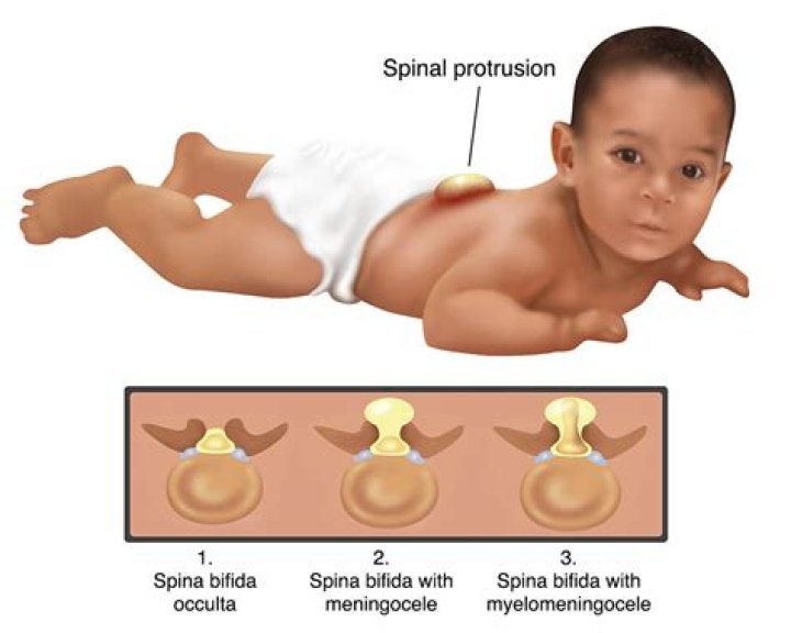 What is spina bifida with Myeloschisis?