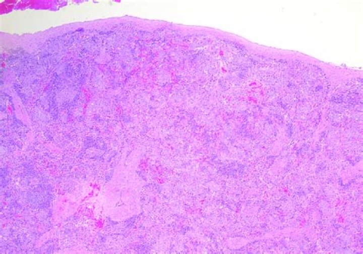 What is Splenitis?