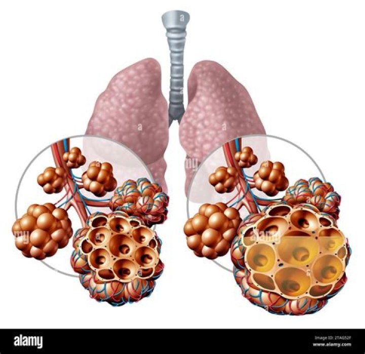 What is teratoma in lungs?