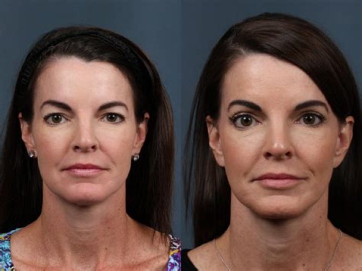What is the best alternative to a face lift?