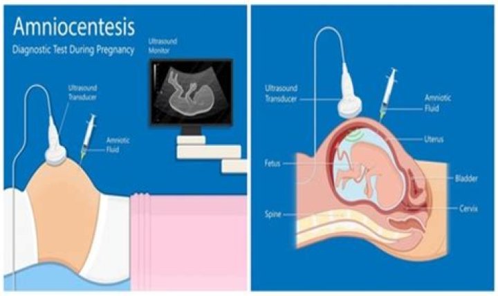 What is the cost of amniocentesis?