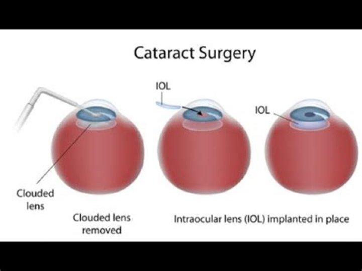 What is the CPT code for cataract removal?