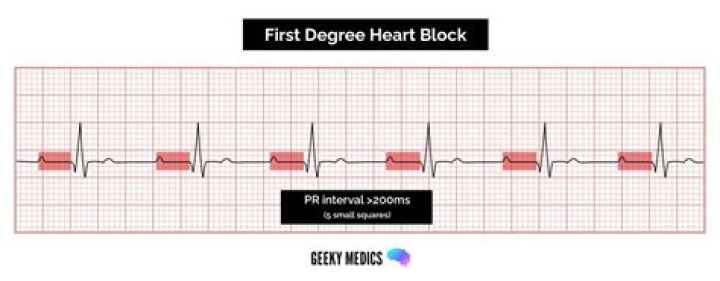 What is the criteria for a first-degree AV block?