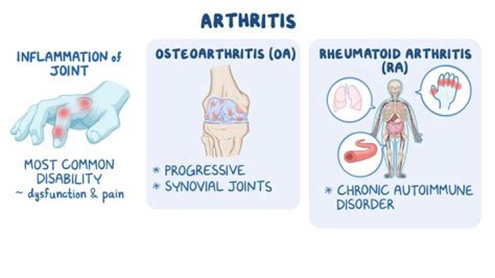 What is the difference between rheumatoid arthritis and reactive arthritis?