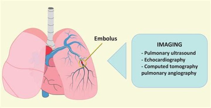 What is the meaning of pulmonary embolism PPT?