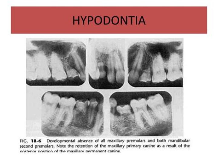 What is the most associated dental anomaly with hypodontia?