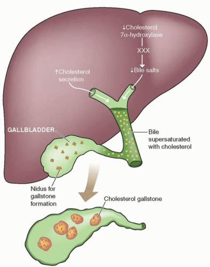 What is the most common cause of gallbladder hydrops?