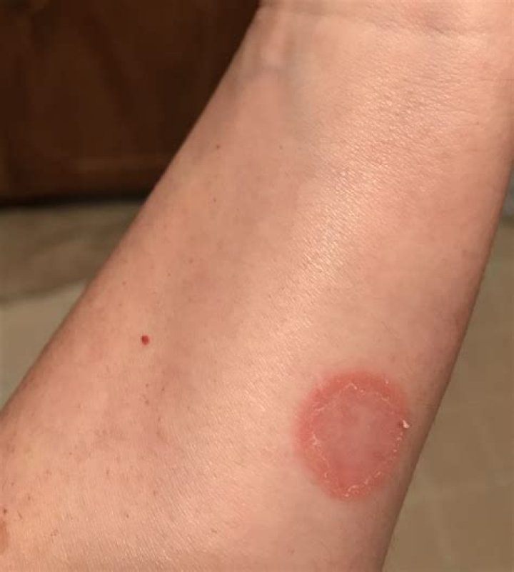 What is the most contagious skin disease?