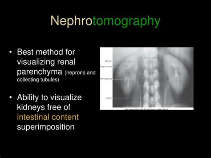 What is the Nephrotomography used for?