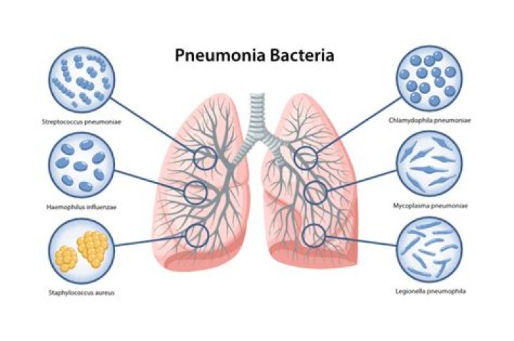 What is the pathophysiology of bacterial pneumonia?