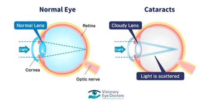 What is the power of vision for normal eye?