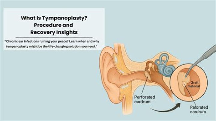 What is the procedure code for tympanoplasty?