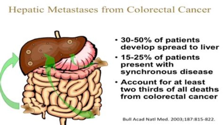 What is the prognosis for colon cancer metastasis to the liver?