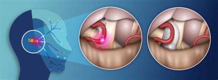 What is the surgery for trigeminal neuralgia?
