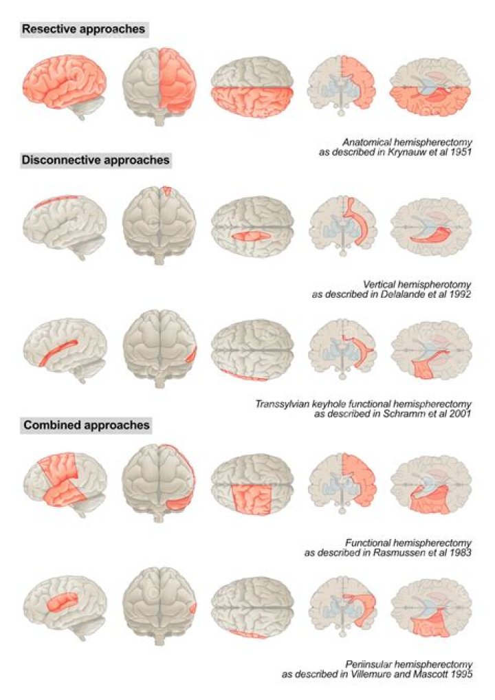 What is the survival rate of a hemispherectomy?