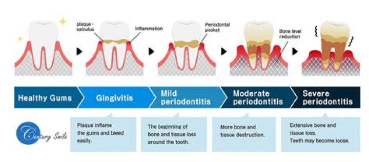 What is the treatment plan for periodontal disease?