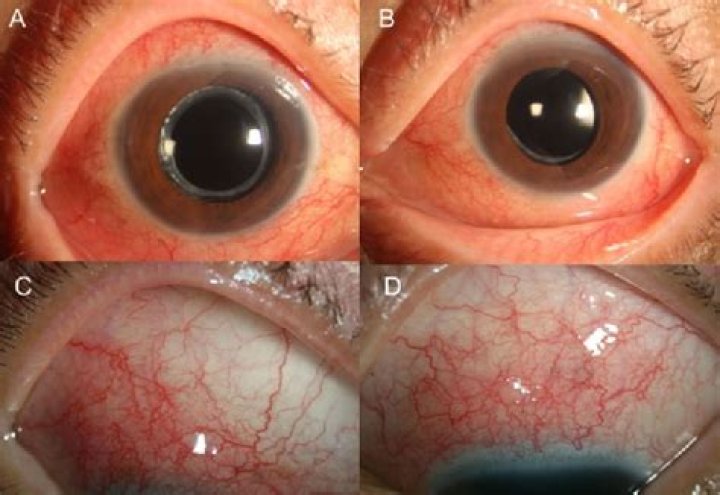What is toxocariasis of the eye?