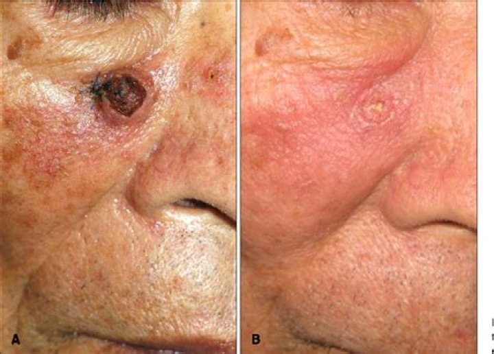 What is treatment of choice for keratoacanthoma?