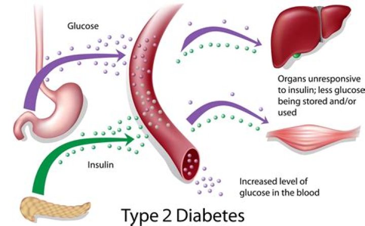 What is type 2 diabetes sugar level?