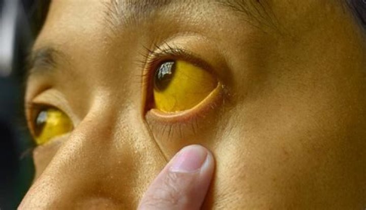 What is Yarkan disease?