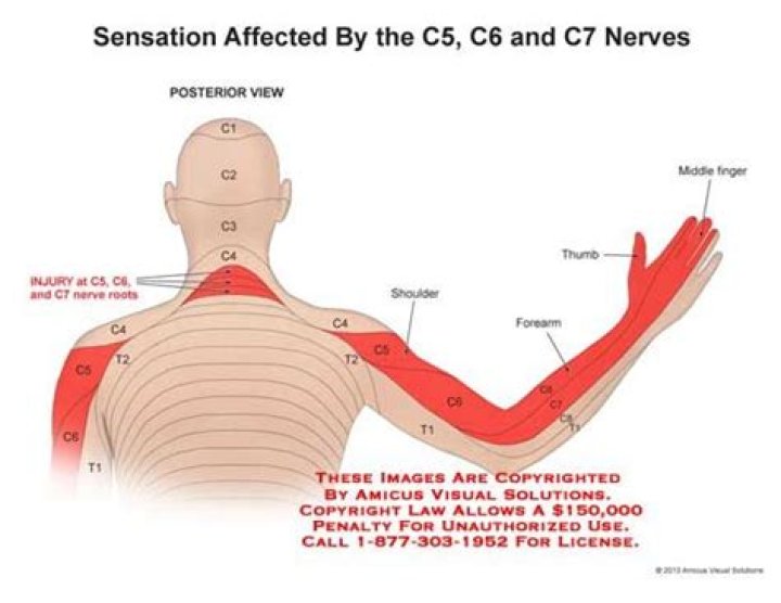What nerves are affected by C5-C6 C7?