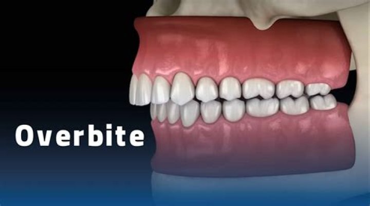 What percent overbite is bad?