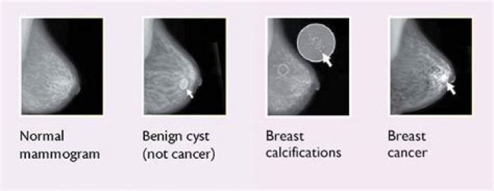 What shape are breast cancer lumps?