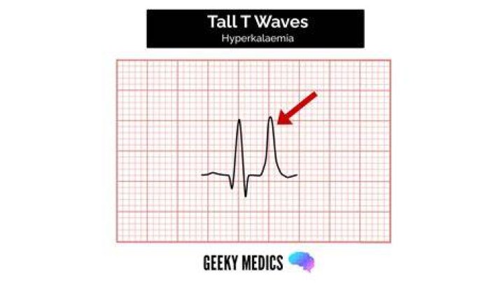 What should an ECG show?