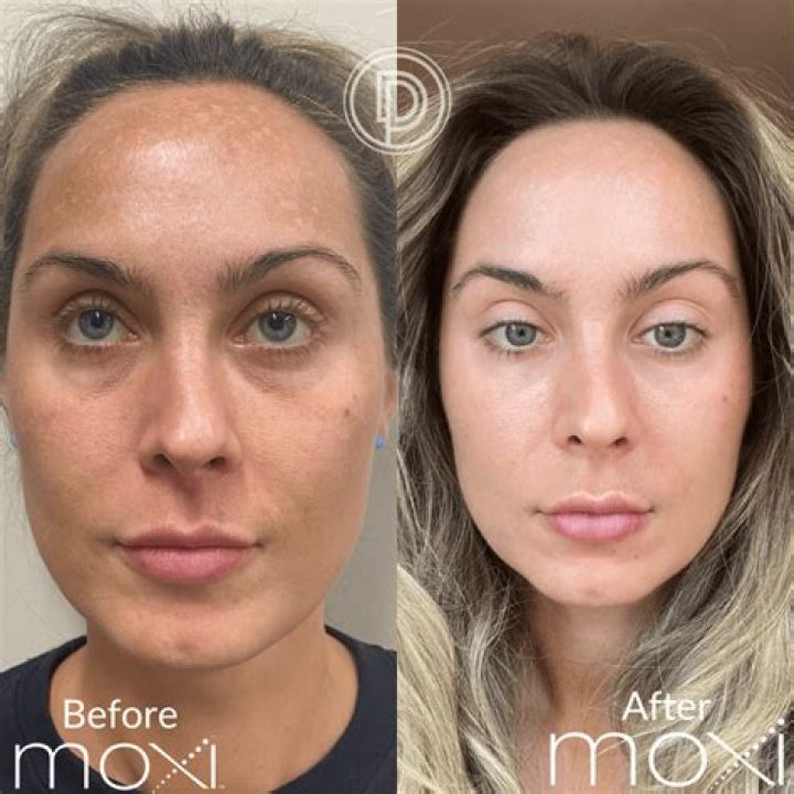 What should I put on my face before epilating?