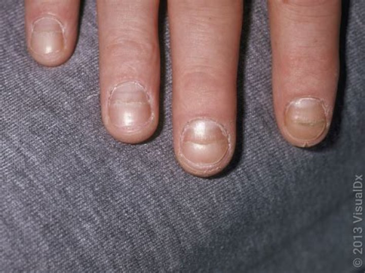 What vitamin deficiency causes black lines on nails?