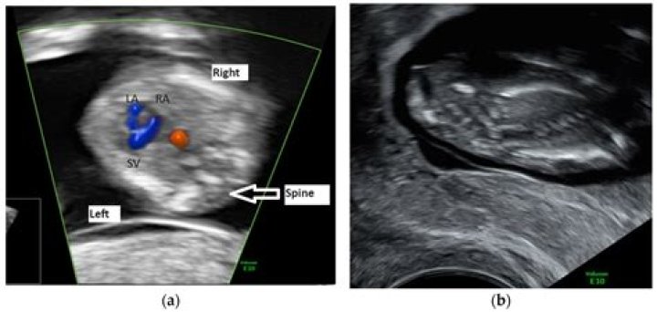 When is body stalk anomaly detected?