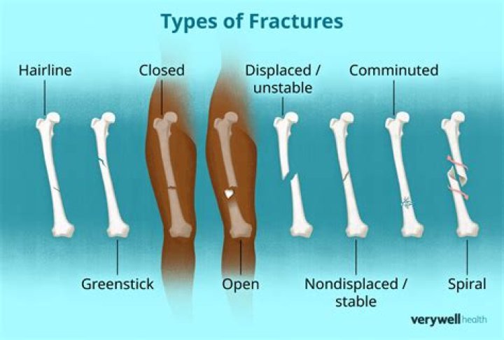 When should a nasal fracture be reduced?