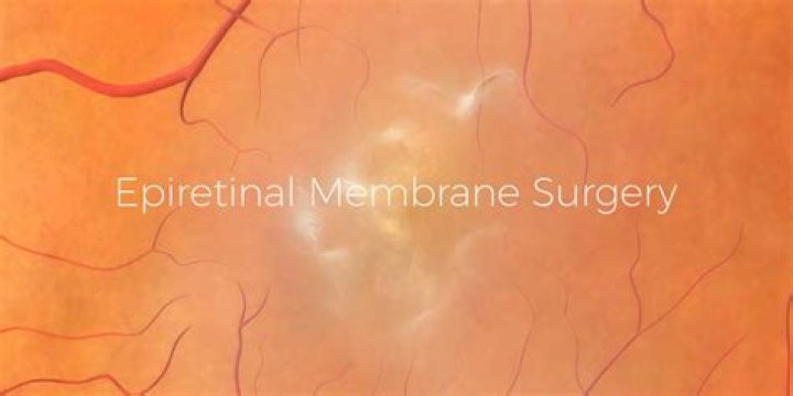 When should you have surgery for epiretinal membrane?