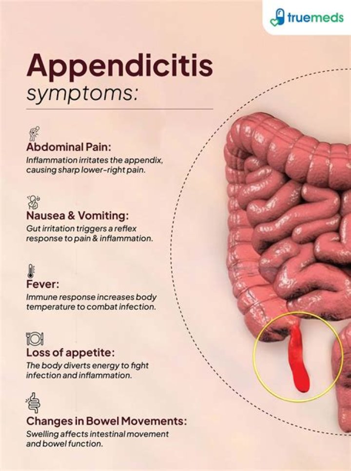 Where can I find information on acute appendicitis?