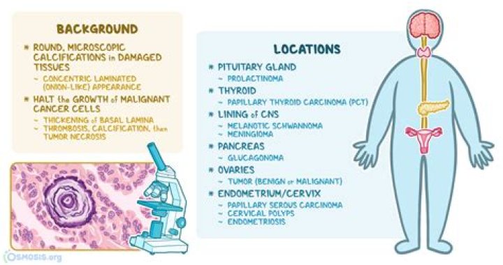 Where can Psammoma bodies be found?