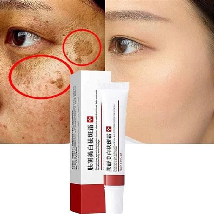 Which cream is best for removing freckles?