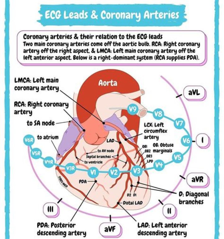Which ECG leads to which coronary arteries?