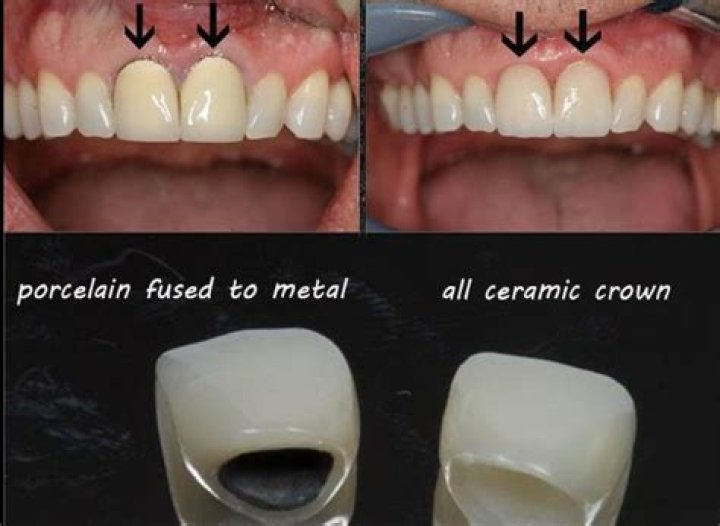 Which is better porcelain crown or metal crown?