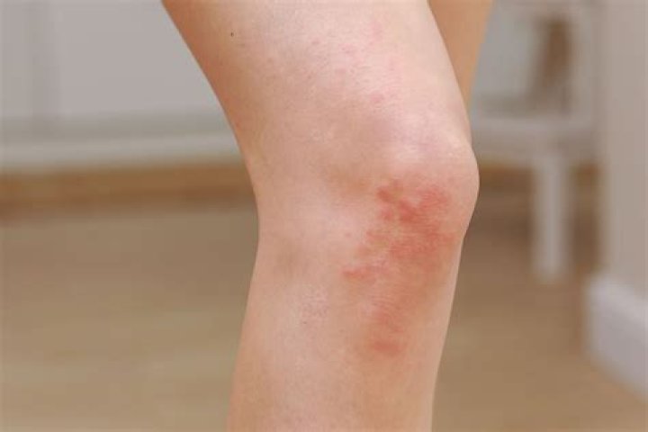 Why are both my knees hot?