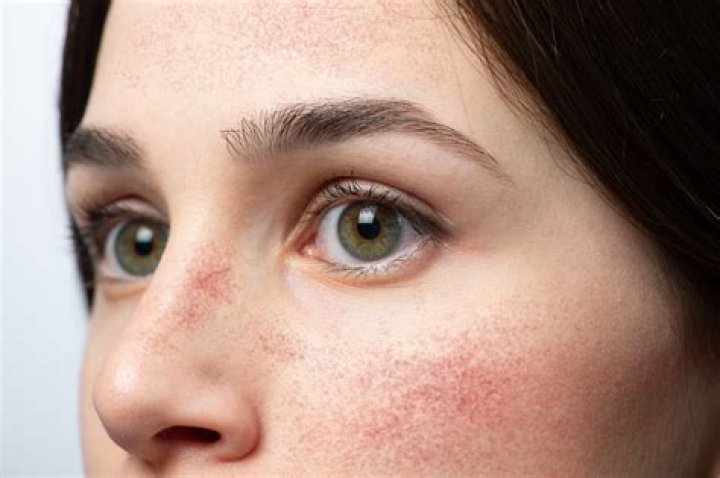 Why are my cheeks inflamed and red?