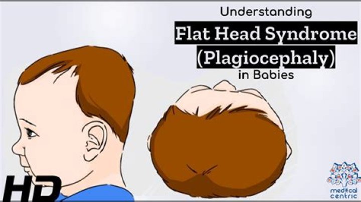 Why do I have a flat spot on the top of my head?