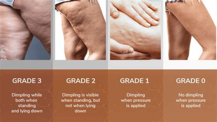 Why do I have so much cellulite on my arms?
